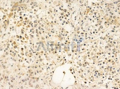 FLII Antibody - DF8003 at 1/100 staining human Hodgkin lymphoma by IHC-P.