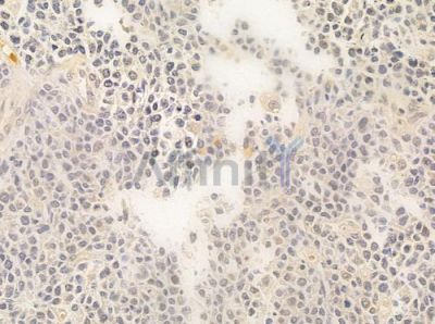 FLII Antibody - DF8003 at 1/100 staining human non-Hodgkin lymphoma by IHC-P.