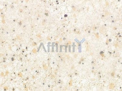 FLII Antibody - DF8003 at 1/100 staining human astrocytoma by IHC-P.
