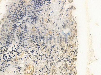 FLII Antibody - DF8003 at 1/100 staining human thyroid carcinoma by IHC-P.