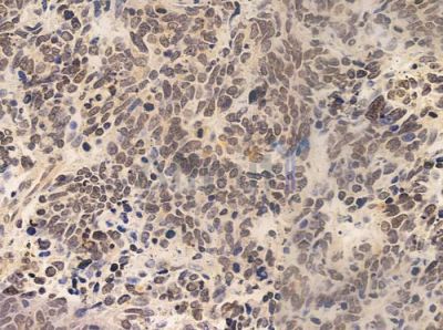 FLII Antibody - DF8003 at 1/100 staining human small cell lung carcinoma by IHC-P.