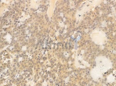 FLII Antibody - DF8003 at 1/100 staining human ovarian carcinoma by IHC-P.