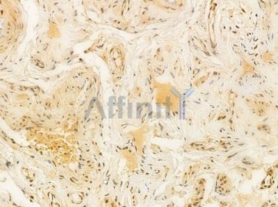 FLII Antibody - DF8003 at 1/100 staining human testicular cancer by IHC-P.