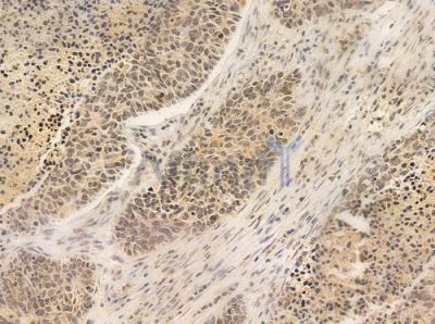 FLII Antibody - DF8003 at 1/100 staining human large cell lung carcinoma by IHC-P.