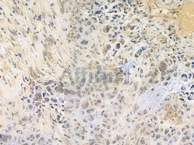 FLII Antibody - DF8003 at 1/100 staining human gastric carcinoma by IHC-P.