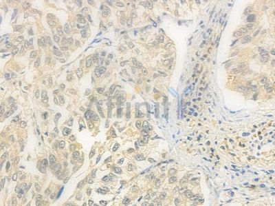 PSMD14 Antibody - DF8011 at 1/100 staining human lung squamous cell carcinoma by IHC-P.
