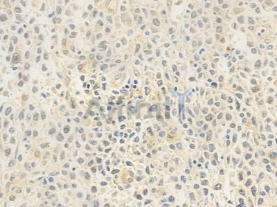 PSMD14 Antibody - DF8011 at 1/100 staining human non-Hodgkin lymphoma by IHC-P.
