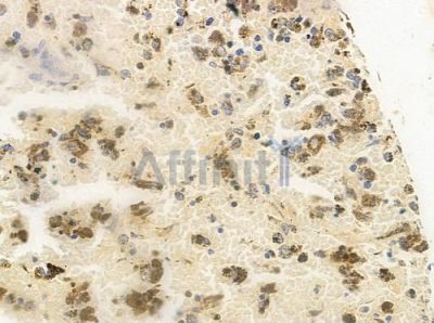 NEUROG2 Antibody - DF8047 at 1/100 staining human melanoma by IHC-P.