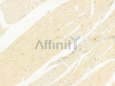 SEMA4D Antibody - DF8058 at 1/100 staining human tongue carcinoma by IHC-P.
