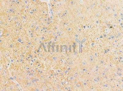 HSPA14 Antibody - DF8060 at 1/100 staining human glioblastoma by IHC-P.