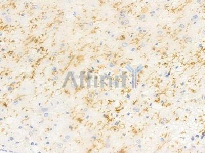 HSPA14 Antibody - DF8060 at 1/100 staining human astrocytoma by IHC-P.
