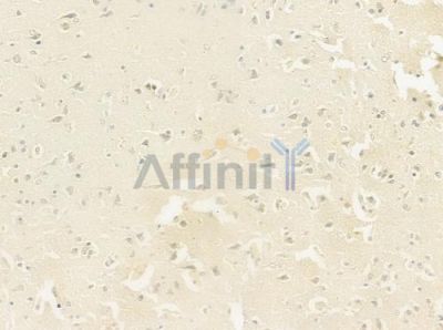 ING3 Antibody - DF8079 at 1/100 staining human glioblastoma by IHC-P.