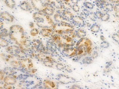 Thymidylate Synthase Antibody - DF8096 at 1/100 staining human renal cell carcinoma by IHC-P.