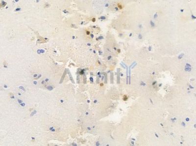 CITED4 Antibody - DF8114 at 1/100 staining human glioblastoma by IHC-P.