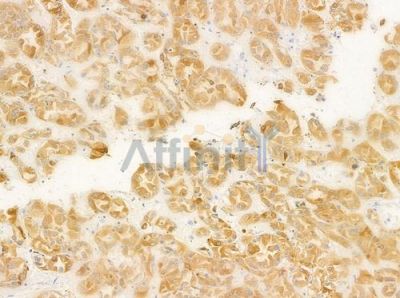 FNTA Antibody - DF8125 at 1/100 staining human renal cell carcinoma by IHC-P.