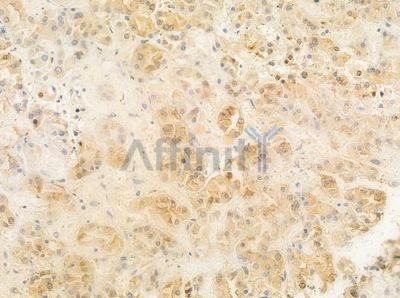PTS Antibody - DF8130 at 1/100 staining human renal cell carcinoma by IHC-P.