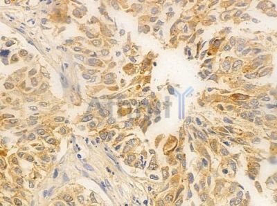 PTS Antibody - DF8130 at 1/100 staining human lung squamous cell carcinoma by IHC-P.