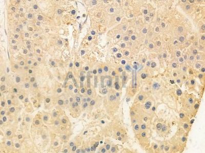 OXT Antibody - DF8139 at 1/100 staining human hepatocellular carcinoma by IHC-P.