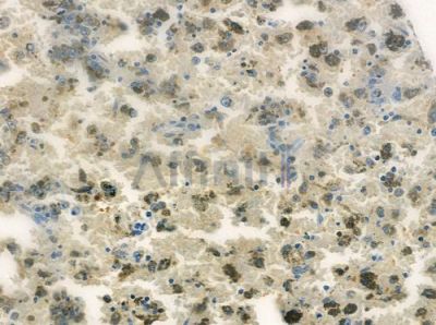 BORA Antibody - DF8147 at 1/100 staining human melanoma by IHC-P.