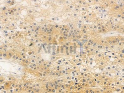 TRIM69 Antibody - DF8161 at 1/100 staining human hepatocellular carcinoma by IHC-P.