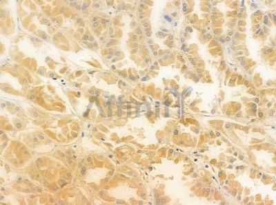 TRIM69 Antibody - DF8161 at 1/100 staining human renal cell carcinoma by IHC-P.