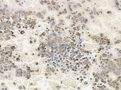 NudC Antibody - DF8191 at 1/100 staining human melanoma by IHC-P.