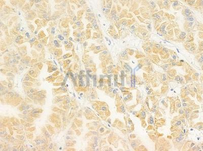 ENTPD2 Antibody - DF8194 at 1/100 staining human renal cell carcinoma by IHC-P.