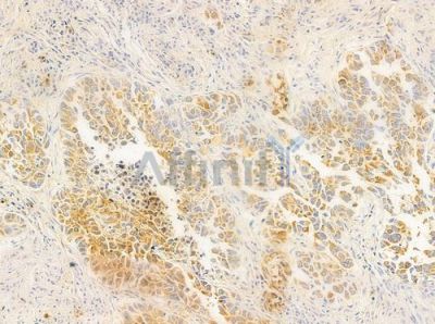ENTPD2 Antibody - DF8194 at 1/100 staining human lung squamous cell carcinoma by IHC-P.