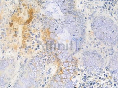 CHRNA4 Antibody - DF8199 at 1/100 staining human colon carcinoma by IHC-P.