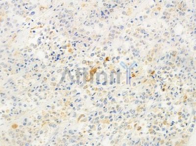 CHRNA4 Antibody - DF8199 at 1/100 staining human prostate carcinoma by IHC-P.