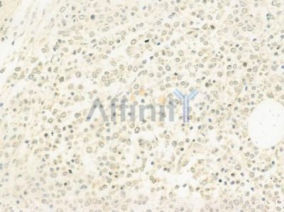 OSR1 Antibody - DF8200 at 1/100 staining human Hodgkin lymphoma by IHC-P.