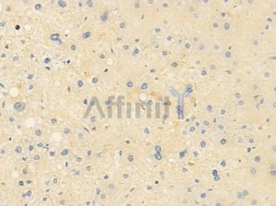 CD163 Antibody - DF8235 at 1/100 staining human hepatocellular carcinoma by IHC-P.