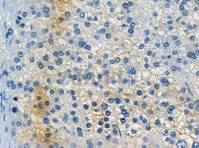 GRK1 Antibody - DF8251 at 1/100 staining human pancreatic carcinoma by IHC-P.