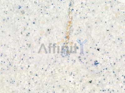 CDH10 Antibody - DF8256 at 1/100 staining human astrocytoma by IHC-P.