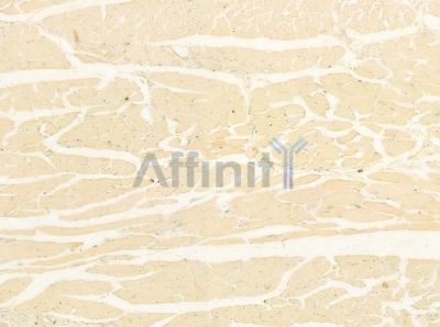 KIF3A Antibody - DF8266 at 1/100 staining human tongue carcinoma by IHC-P.