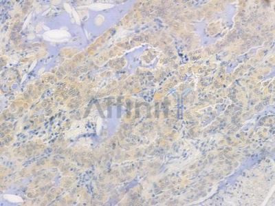 Proteasome 20S alpha 5 Antibody - DF8268 at 1/100 staining human lung adenocarcinoma by IHC-P.