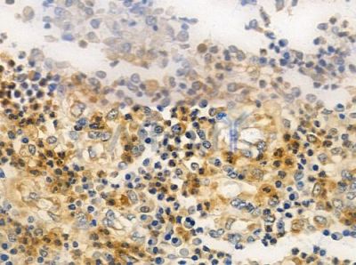 TNPO3 Antibody - DF8297 at 1/100 staining human colon carcinoma by IHC-P.