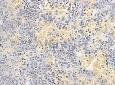DCTN3 Antibody - DF8351 at 1/100 staining human melanoma by IHC-P.
