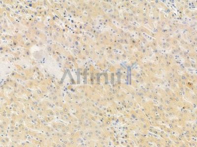CENPE Antibody - DF8371 at 1/100 staining human hepatocellular carcinoma by IHC-P.