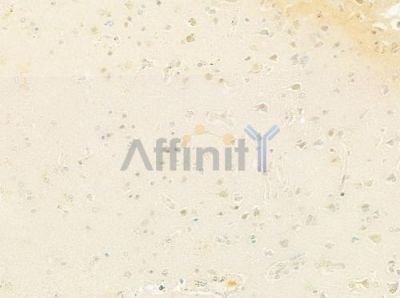TLS/FUS Antibody - DF8391 at 1/100 staining human glioblastoma by IHC-P.
