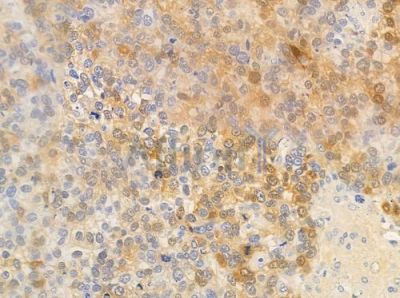 RYK Antibody - DF8392 at 1/100 staining human astrocytoma by IHC-P.