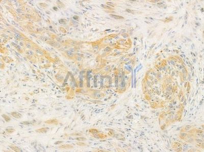 AVPR1A Antibody - DF8394 at 1/100 staining human tongue carcinoma by IHC-P.
