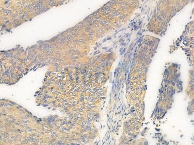 EIF3B Antibody - DF8429 at 1/100 staining human cervical carcinoma by IHC-P.