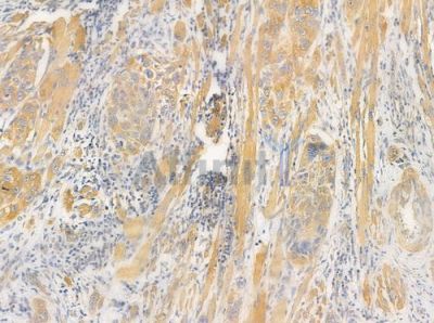 EIF3B Antibody - DF8429 at 1/100 staining human tongue carcinoma by IHC-P.