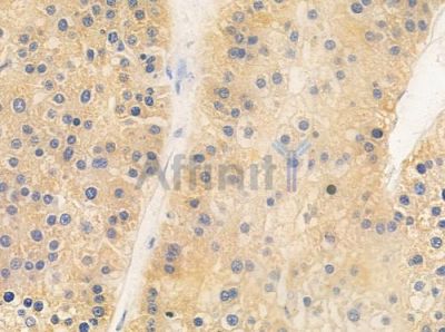 EIF3B Antibody - DF8429 at 1/100 staining human hepatocellular carcinoma by IHC-P.