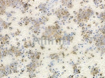 DOCK2 Antibody - DF8431 at 1/100 staining human melanoma by IHC-P.
