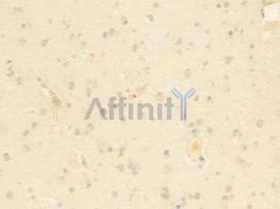 MGEA5 Antibody - DF8436 at 1/100 staining human glioblastoma by IHC-P.
