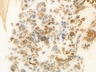 THOC1 Antibody - DF8456 at 1/100 staining human lung squamous cell carcinoma by IHC-P.