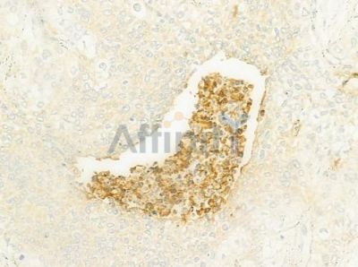 ATP5J2 Antibody - DF8505 at 1/100 staining human cervical carcinoma by IHC-P.