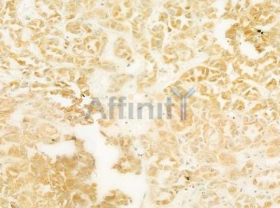 ATP7A Antibody - DF8506 at 1/100 staining human renal cell carcinoma by IHC-P.